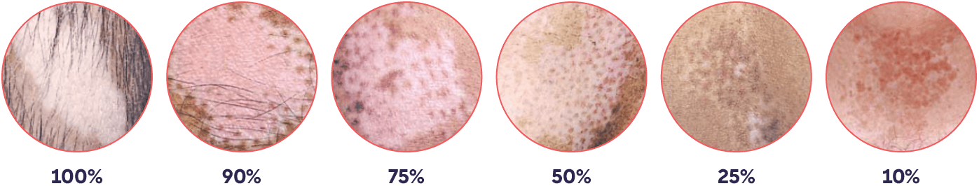 Image showing vitiligo lesions and VASI score.