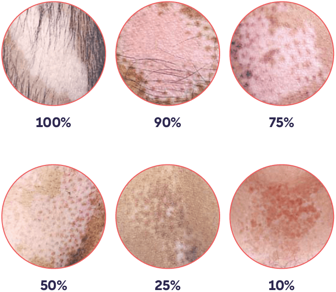 Image showing vitiligo lesions and VASI score.