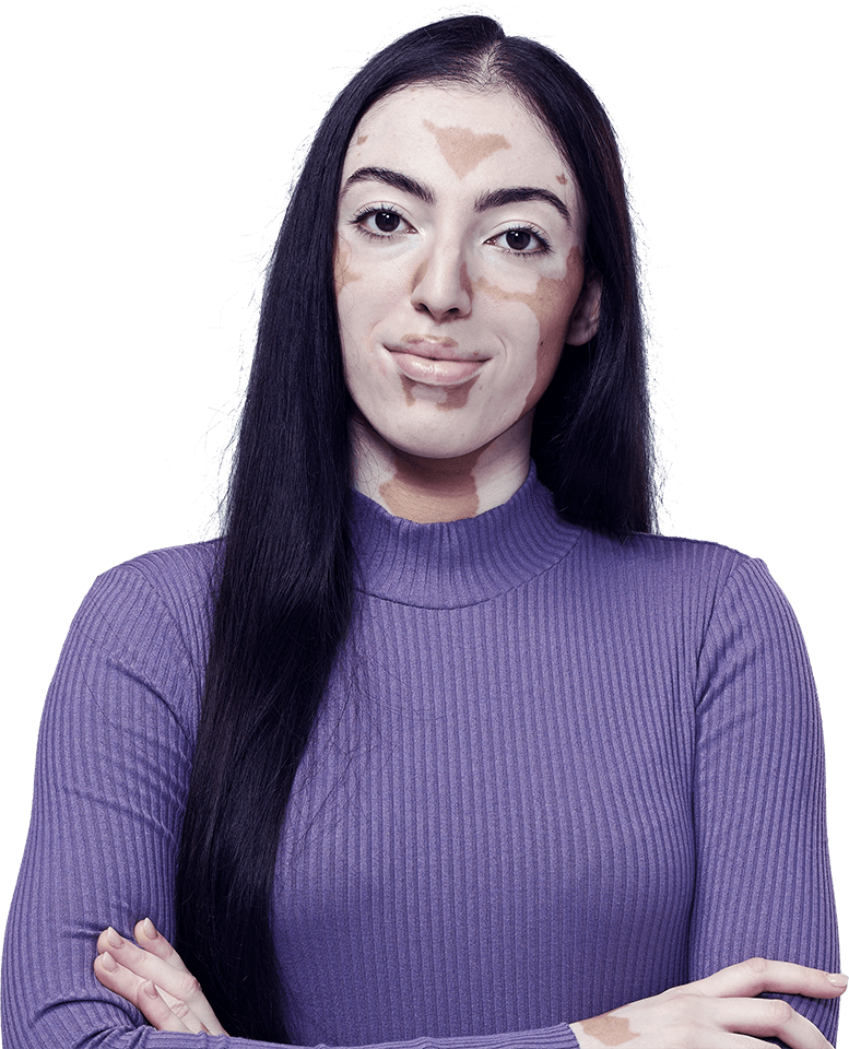 Woman with non-segmental vitiligo surrounded by information on how to apply Opzelura® (ruxolitinib) topical cream 15 mg/g