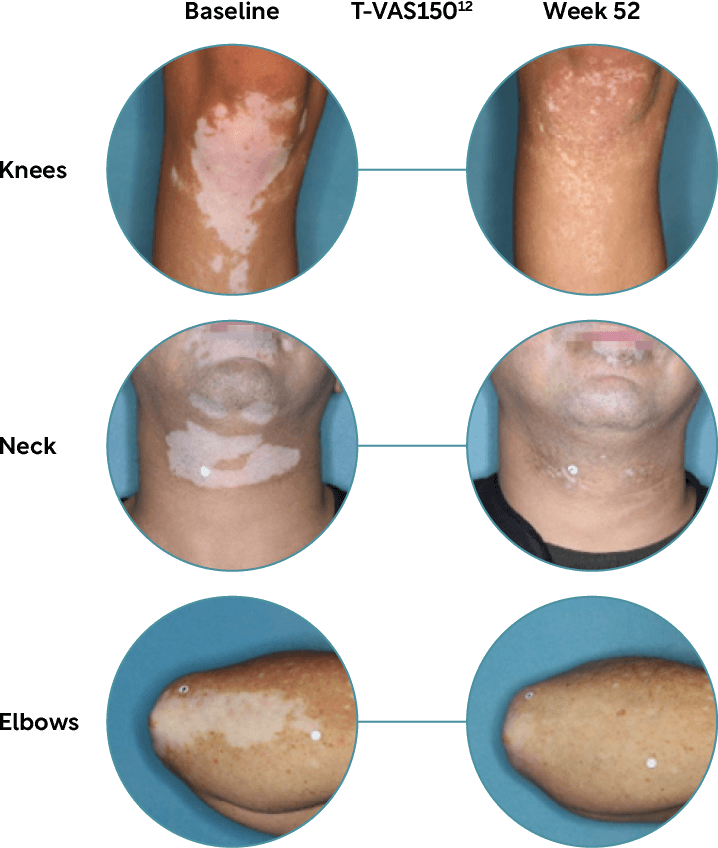 Opzelura body repigmentation results from baseline to week 52.