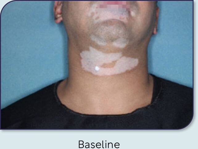 Patient 15: Vitiligo score and Opzelura® results - Baseline