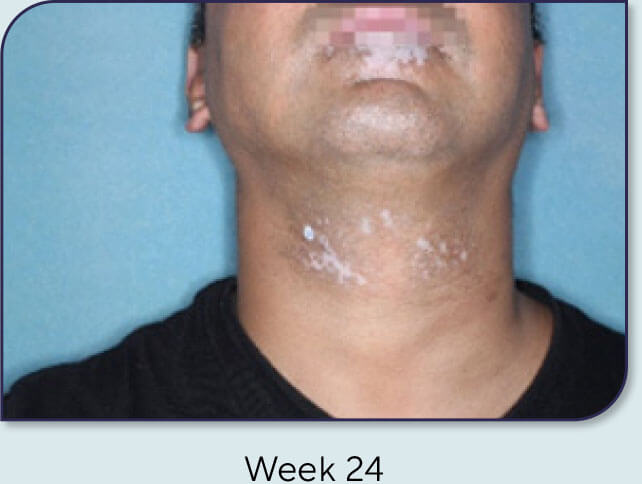 Patient 15: Vitiligo score and Opzelura® results - Week 24