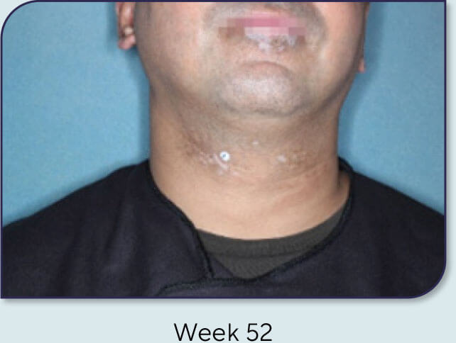 Patient 15: Vitiligo score and Opzelura® results - Week 52