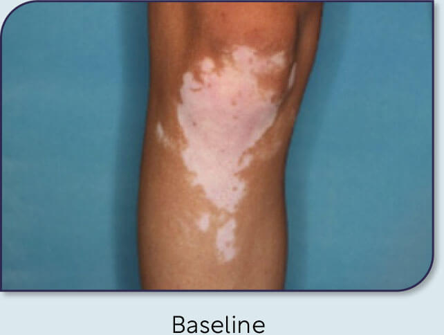 Patient 16: Vitiligo score and Opzelura® results - Baseline