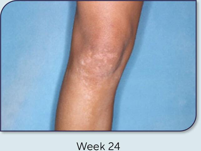 Patient 16: Vitiligo score and Opzelura® results - Week 24