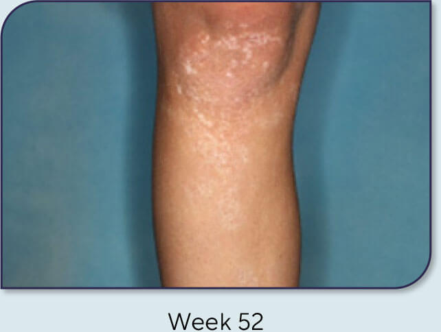 Patient 16: Vitiligo score and Opzelura® results - Week 52