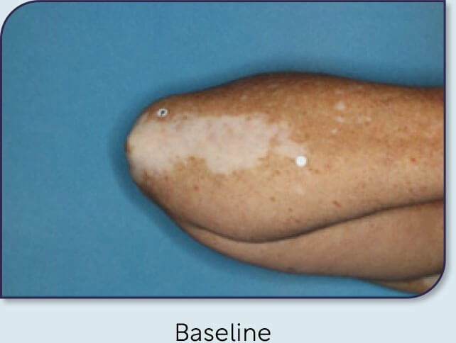 Patient 18: Vitiligo score and Opzelura® results - Baseline