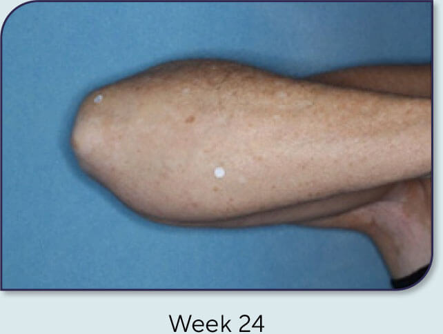 Patient 18: Vitiligo score and Opzelura® results - Week 24