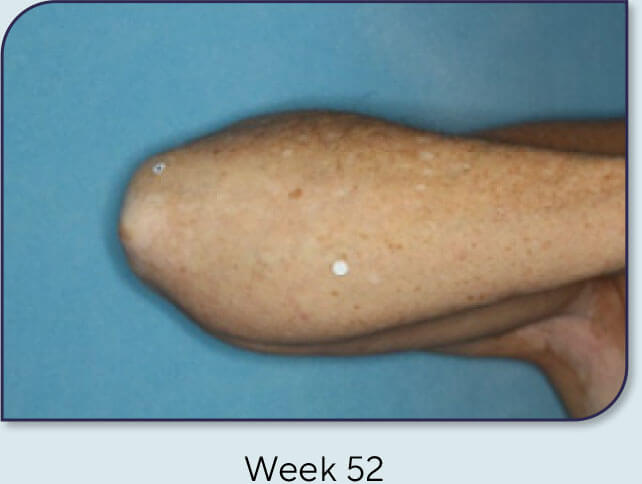 Patient 18: Vitiligo score and Opzelura® results - Week 52