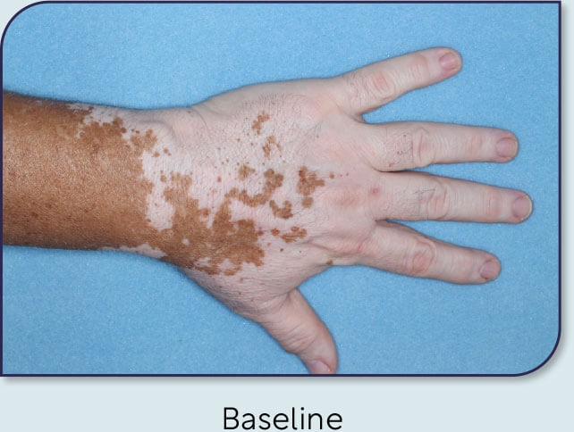 Patient 20: Vitiligo score and Opzelura® results - Baseline