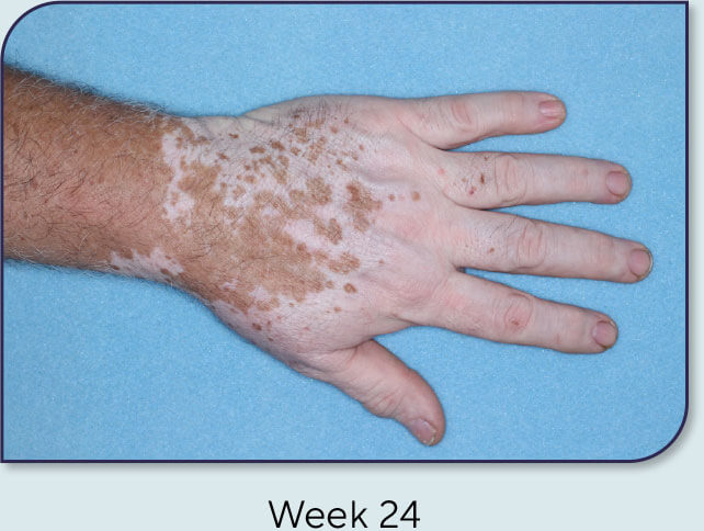 Patient 20: Vitiligo score and Opzelura® results - Week 24