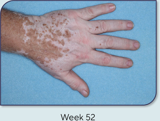 Patient 20: Vitiligo score and Opzelura® results - Week 52