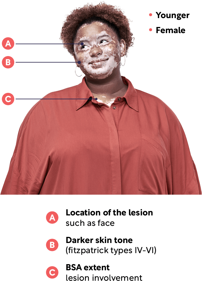 Woman with non-segmental vitiligo surrounded by information on non-segmental vitiligo global demographics.