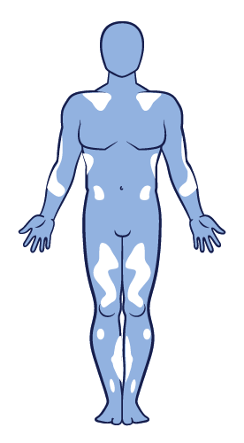 Image showing the distribution of non-segmental vitiligo on the body.