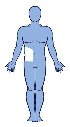 Image showing the distribution of segmental vitiligo on the body.